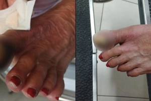 Idosa aguarda h&aacute; 20 dias por cirurgia em hospital regional de Joinville e corre risco de amputa&ccedil;&atilde;o, diz fam&iacute;lia