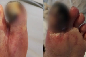 Idosa deixa UTI ap&oacute;s cirurgia, mas ter&aacute; dedo amputado em Joinville