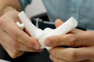 Impressora chinesa que produz ossos ajuda no tratamento de fraturas no Hospital S&atilde;o Jos&eacute;, em Joinville