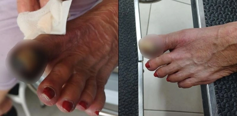 Idosa aguarda h&aacute; 20 dias por cirurgia em hospital regional de Joinville e corre risco de amputa&ccedil;&atilde;o, diz fam&iacute;lia