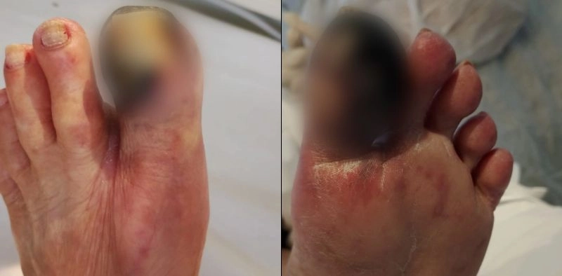 Idosa deixa UTI ap&oacute;s cirurgia, mas ter&aacute; dedo amputado em Joinville