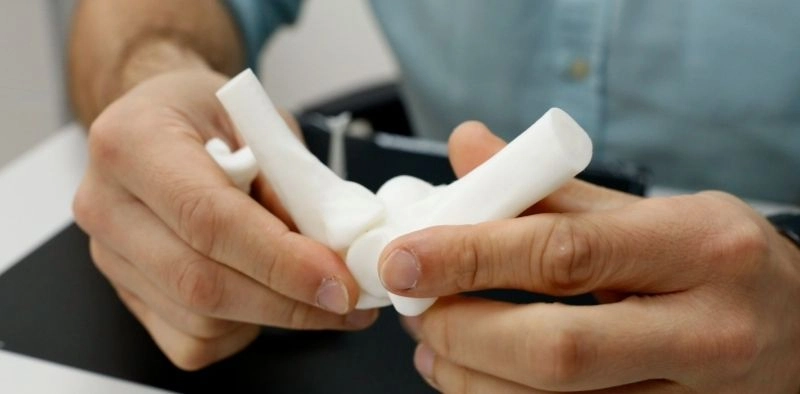 Impressora chinesa que produz ossos ajuda no tratamento de fraturas no Hospital S&atilde;o Jos&eacute;, em Joinville